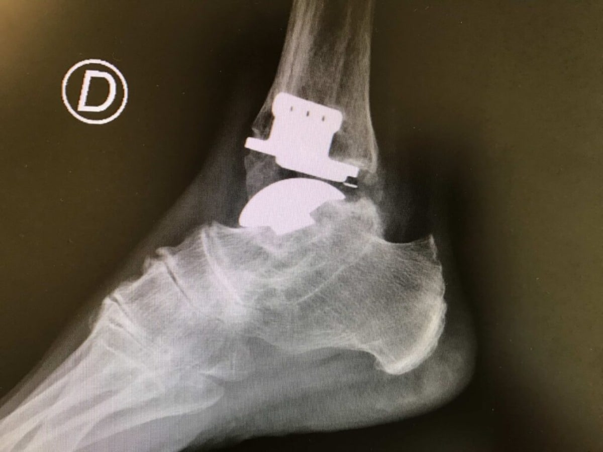 radio en gros plan d'une cheville avec prothèse