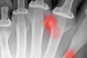 Fracture du 5ème métatarse : durée de consolidation et traitement